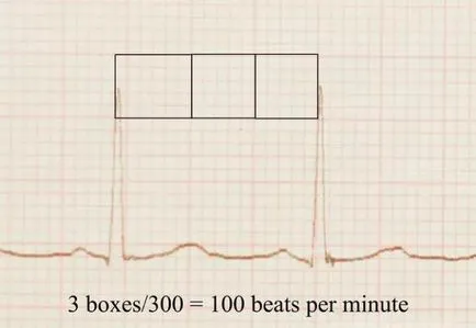 Cum de a citi un ECG cum să descifreze o electrocardiogramă care le prezinta ECG, despre fast