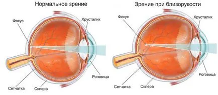 Какво капки използва за късогледство, за очно заболяване