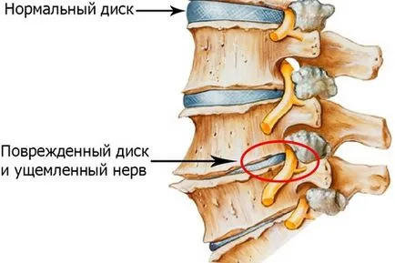 Ce sare depus în disconfortul coloanei vertebrale în timpul depunerii de săruri