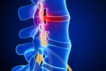 Какво сол депозиран в дискомфорт на гръбначния стълб при отлагане на соли