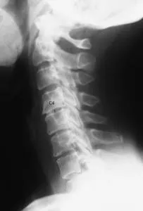 Cum de a determina osteochondrosis a simptomelor coloanei cervicale si diagnostic