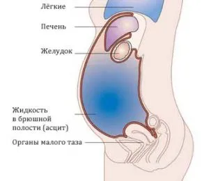 Диуретиците с коремна асцит трева, лекарства