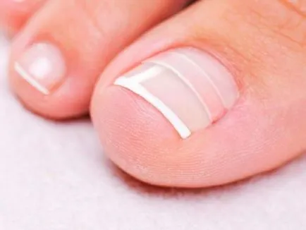 Cum de a reduce inflamația în deget cu unghiile incarnate, revista de frumusete pentru femei