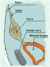 Urahusa simptome chist, tratament, descriere