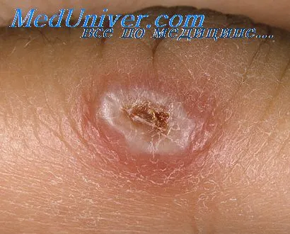 Herpes simplex Clinic