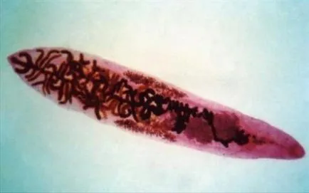 пречиствателни Clonorchiasis, симптоми, диагностика, снимки