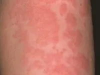 Urticaria - Tünetek, kezelés, megelőzés