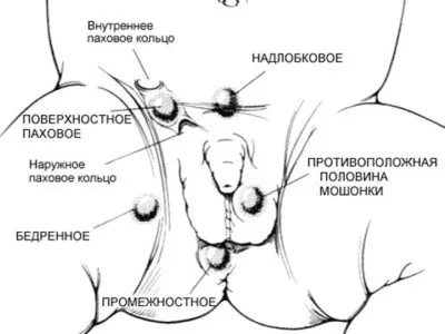 Крипторхизъм оперативно лечение и лекарството, неговата ефикасност и разходите