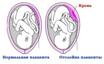 Кървене по време на бременност