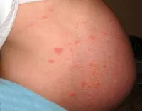 Az allergiás dermatitis kezelési terhesség