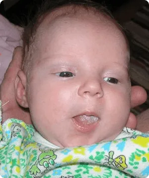 Kezelése szájpenész csecsemők leghatékonyabb módja