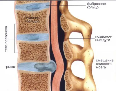 Лечение на дискова херния на гръбначния стълб
