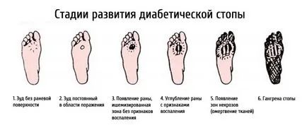 A diabéteszes láb - FGBU Kórház irányítása ügyeit az orosz elnök