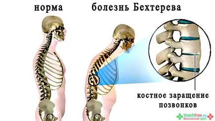 Лечение на анкилозиращ спондилит в санаториумите на Урал и България цени 2017