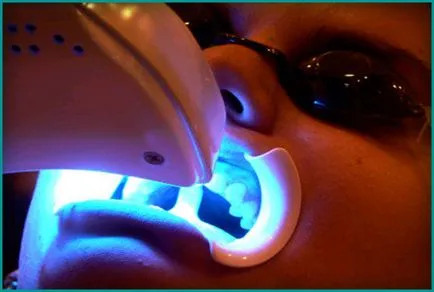 înălbirea dinților cu laserul pro și contra, indicații pentru procedura