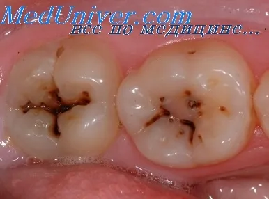 Kezelése periodontális fertőzések