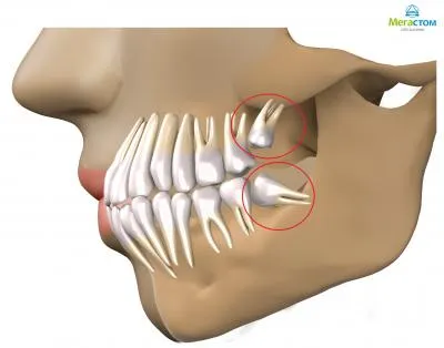 Лечение на мъдрост зъби (осем)