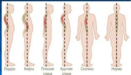 Lordosis az ágyéki és nyaki osztályok gipolordoz és hyperlordosis