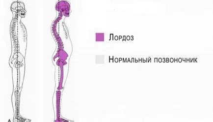 Lordosis az ágyéki és nyaki osztályok gipolordoz és hyperlordosis