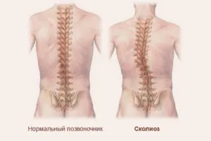 Manual de terapie pentru indicații scolioze, contraindicații