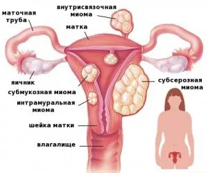 Матката размер фиброма за работа в милиметри, см и седмици