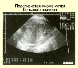 Fibromul uterin - diagnosticare cu ultrasunete