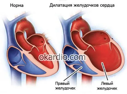 Митрална стеноза причини, симптоми и лечение на стадий на болестта