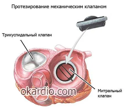 Митрална стеноза причини, симптоми и лечение на стадий на болестта