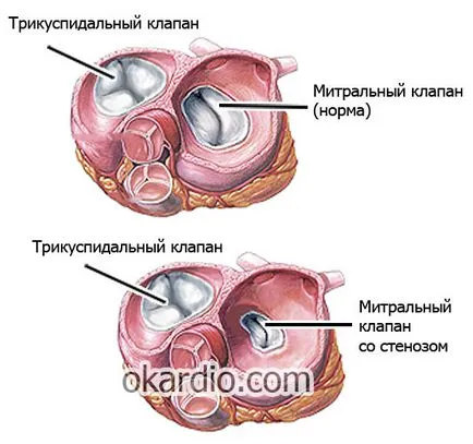 Митрална стеноза причини, симптоми и лечение на стадий на болестта