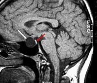 MRI на хипофизната жлеза - цената на хипофизната ЯМР с контраст