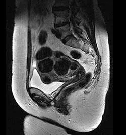 MRI на органите на малкия таз - подготовката и разходите за ядрено-магнитен резонанс на органите на малкия таз