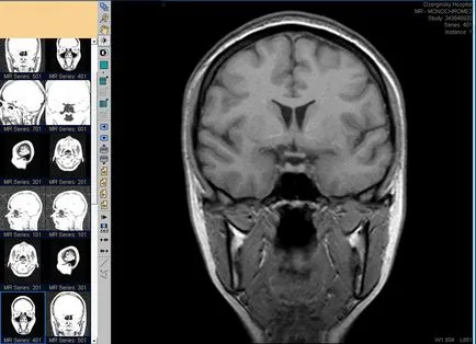 MRI az agyalapi mirigy Moszkva árakat MRI kontraszt, ahol jobb, hogy nem a hypothalamus kontraszt