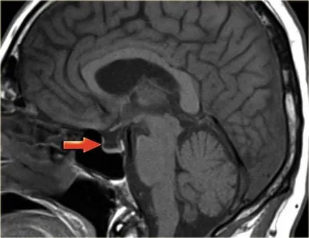 MRI az agyalapi mirigy Moszkva árakat MRI kontraszt, ahol jobb, hogy nem a hypothalamus kontraszt