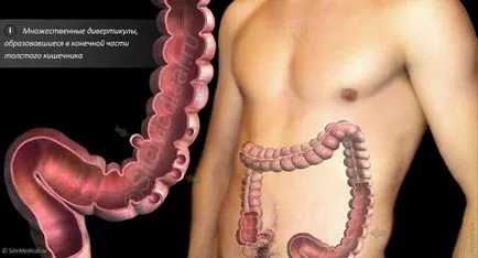 A hagyományos kezelési módszerek a diverticulosis