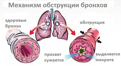 Obstruktív bronchitis tünetei gyermekekben, belélegzés