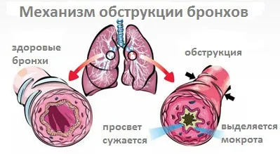 Обструктивен бронхит симптоми при деца, при вдишване