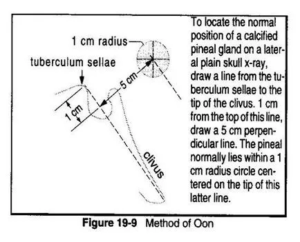 Sondaj spondylograms gât spondylograms parametrii normali radiografice