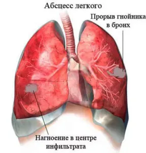 Complicațiile de pneumonie la adulți, caracteristici și modalități de tratament