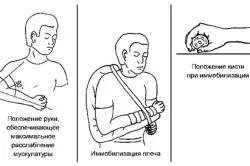 Наслагване гуми предмишницата фрактура