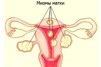 În cazul în care nu fibromului uterin cauzeaza simptome