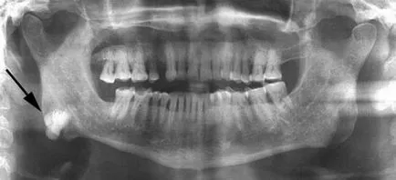 osteomul osteoid simptomele de oase, diagnostic, și regimul de tratament