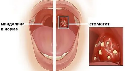 A stomatitis gyógyszert gyermekek számára - kiválasztani a legjobb!