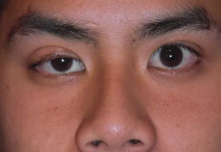felső szemhéj duzzanat oka, hogy okozhat bőrpír