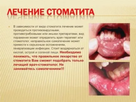 A stomatitis gyógyszert gyermekek számára - kiválasztani a legjobb!