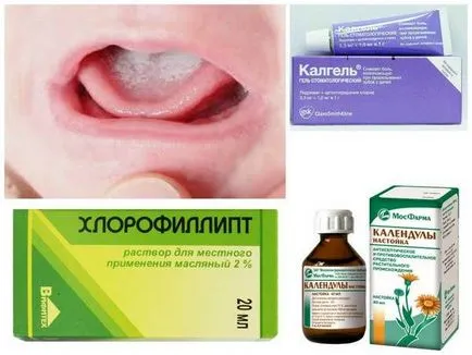 A stomatitis gyógyszert gyermekek számára - kiválasztani a legjobb!