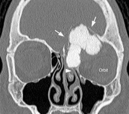 osteomul osteoid simptomele de oase, diagnostic, și regimul de tratament