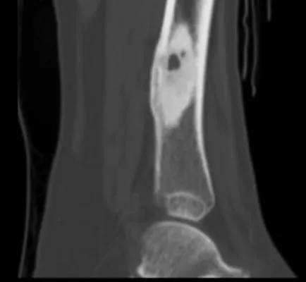 Osteoid oszteóma a csont tünetek, diagnózis, és kezelési rend