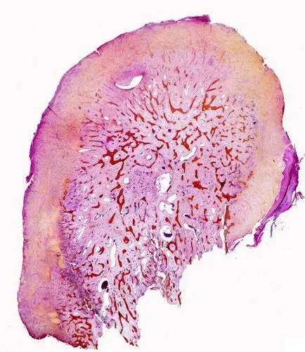 osteomul osteoid simptomele de oase, diagnostic, și regimul de tratament