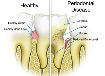 A periodontális betegség ragályos, ha a különbség a periodontális betegség okozza és a kezelés