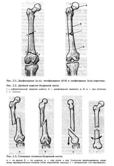 Csonttörések - törések és a csontok sérülései - műtéti és kezelési